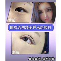 上海眼综合整形|上海吸脂瘦身