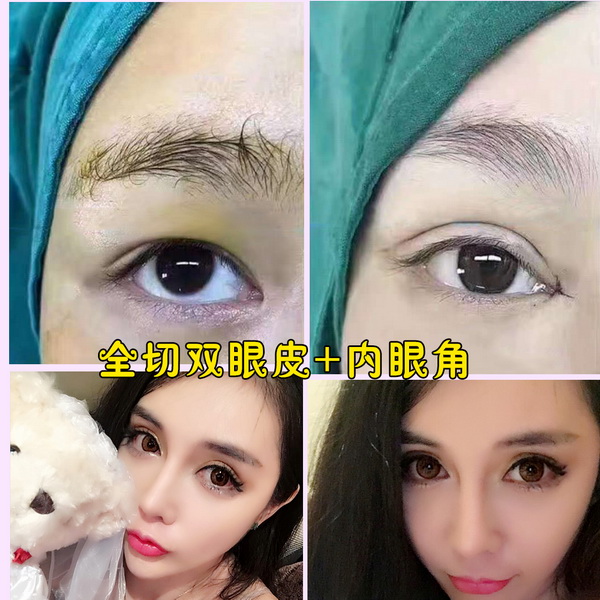 上海眼综合整形|上海吸脂瘦身