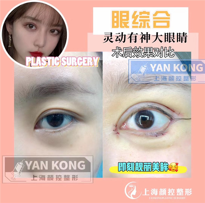 上海眼综合整形