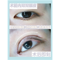 上海网红常去的整形|上海眼综合整形