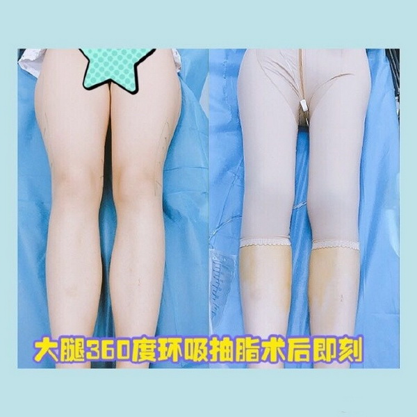 上海丰胸整形哪家好|上海全脸脂肪填充