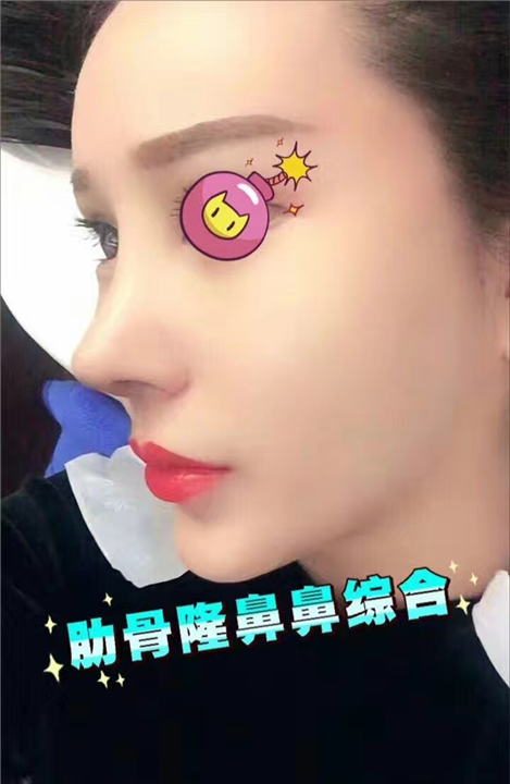 颜控鼻综合整形