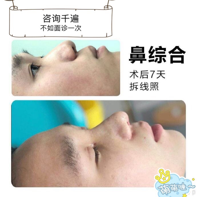 颜控鼻综合整形