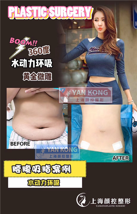 上海抽脂哪家专业