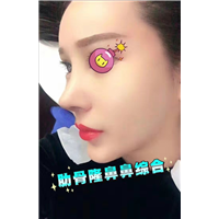 颜控鼻综合整形