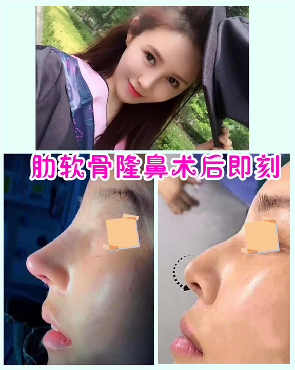 颜控鼻综合整形
