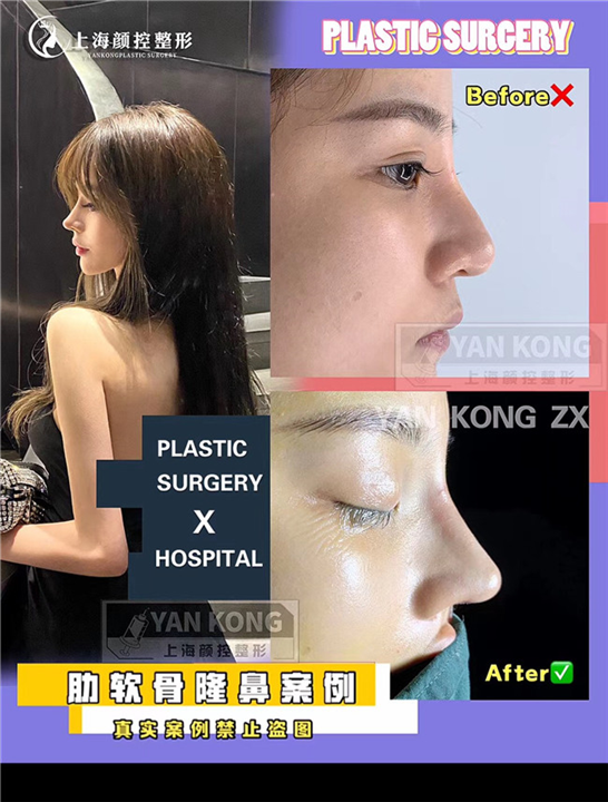 上海鼻整形修复专家