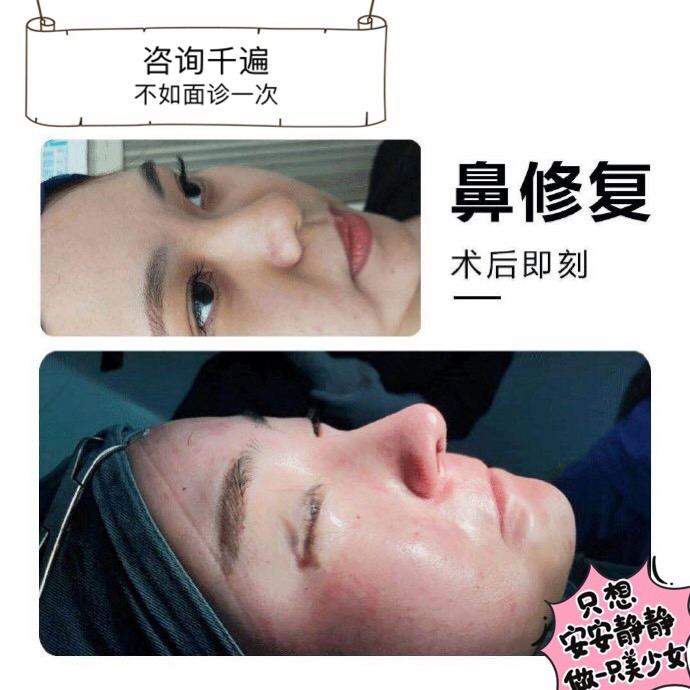 颜控鼻综合整形