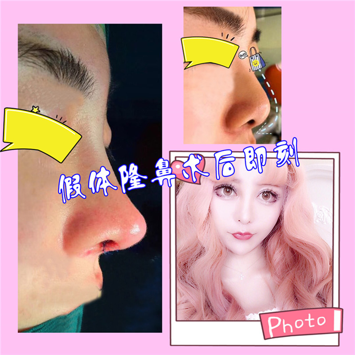 颜控鼻综合整形