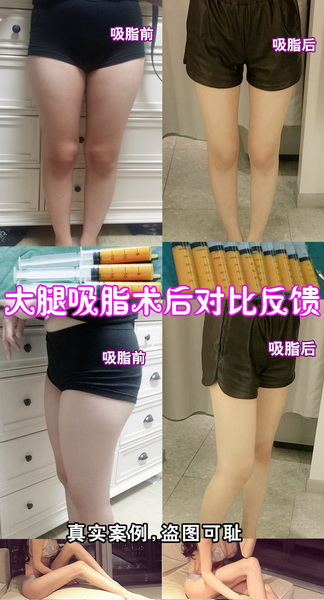 上海全脸脂肪填充|上海全脸打造