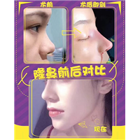 颜控鼻综合整形
