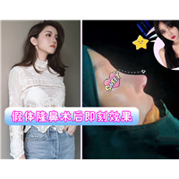 颜控鼻综合整形