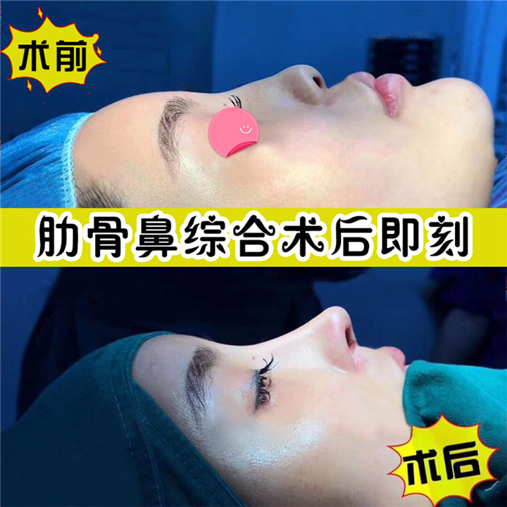 颜控鼻综合整形