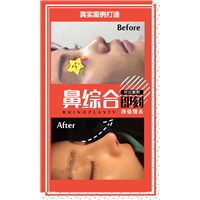 颜控鼻综合整形