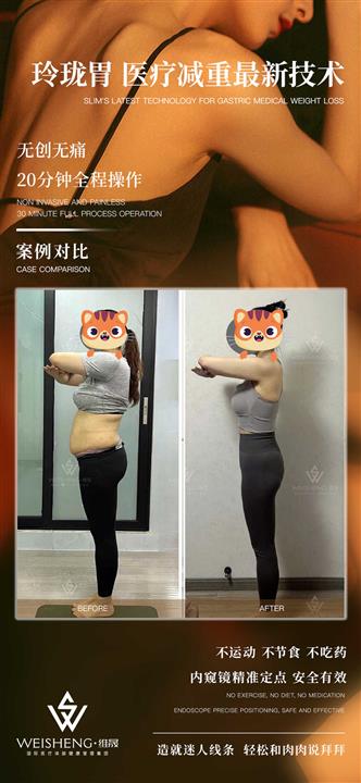 胃内注射减重