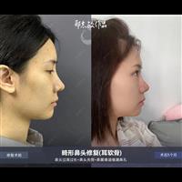 郑志敏隆鼻医生网红高鼻头尖鼻头修复改善案例