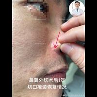 郑志敏鼻整形鼻翼外切手术后1年