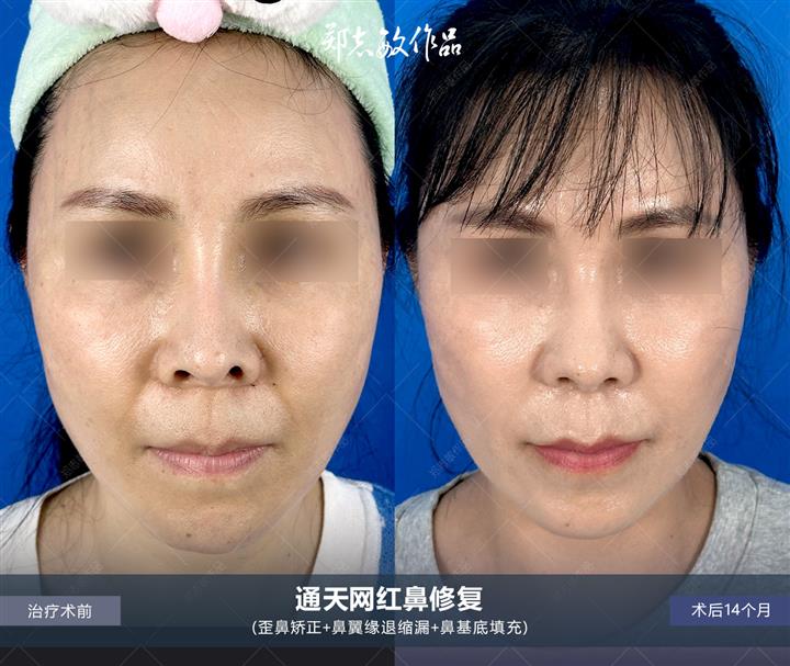 郑志敏医生全肋修复网红通天鼻