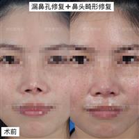 郑志敏院长露鼻孔修复和鼻头畸形修复案例