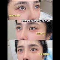 上海娜慕馨禾卧蚕注射
