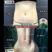 上海娜慕整形腰腹吸脂