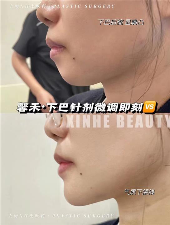 上海 娜慕馨禾下巴微调