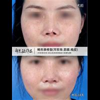 郑志敏畸形鼻头缺损修复