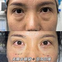 郑志敏医生无痕去眼袋
