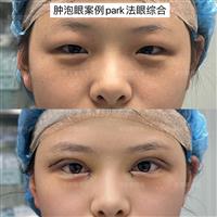 郑志敏医生肿泡眼眼综合案例