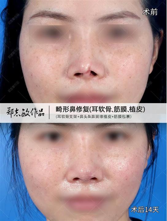 郑志敏畸形鼻头缺损修复
