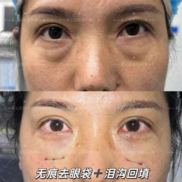 郑志敏医生无痕去眼袋