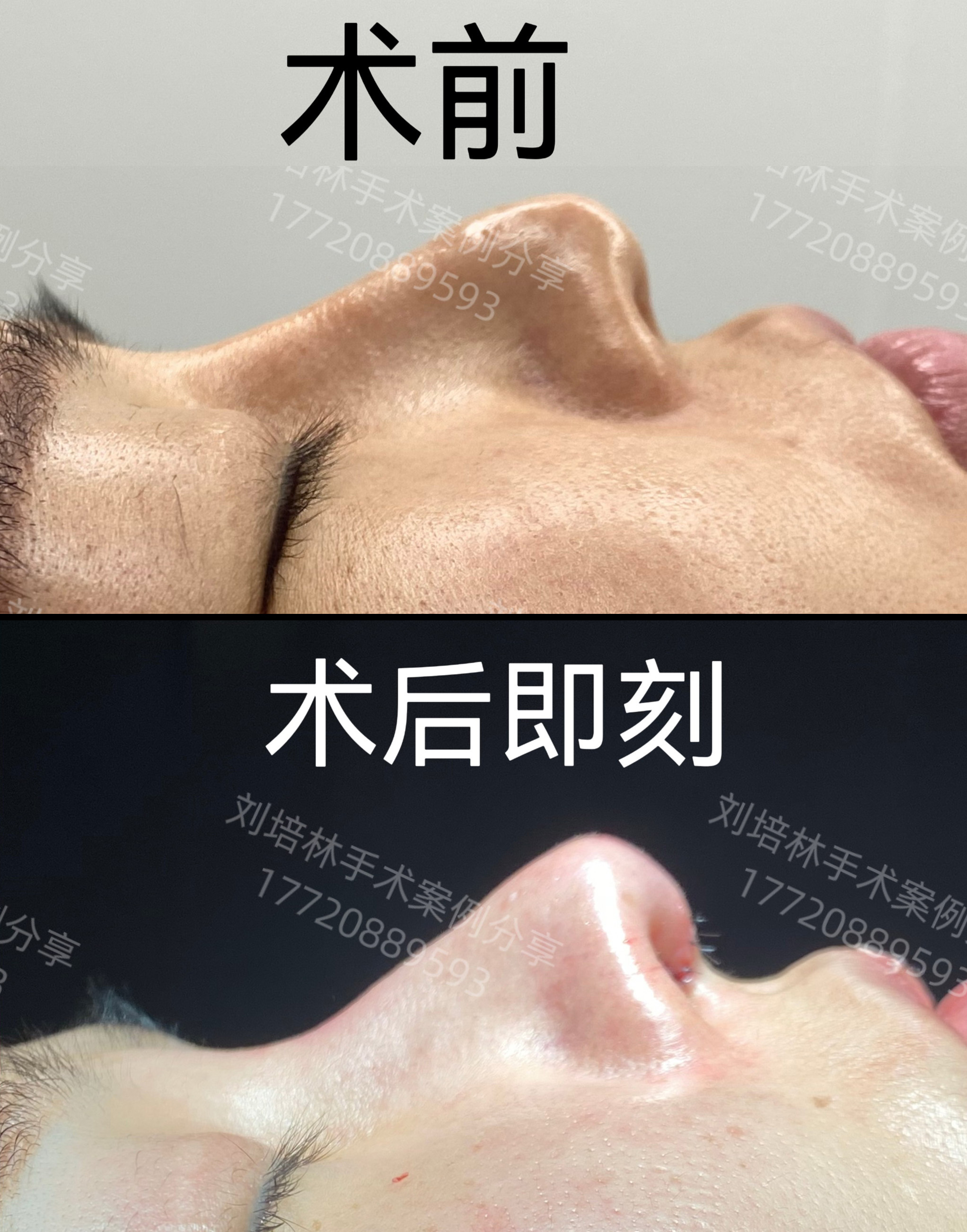 修复鼻案例