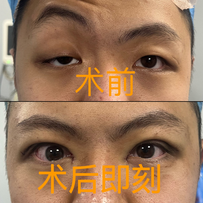 CFS矫正重度上睑下垂案例